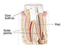 nm endo post n core